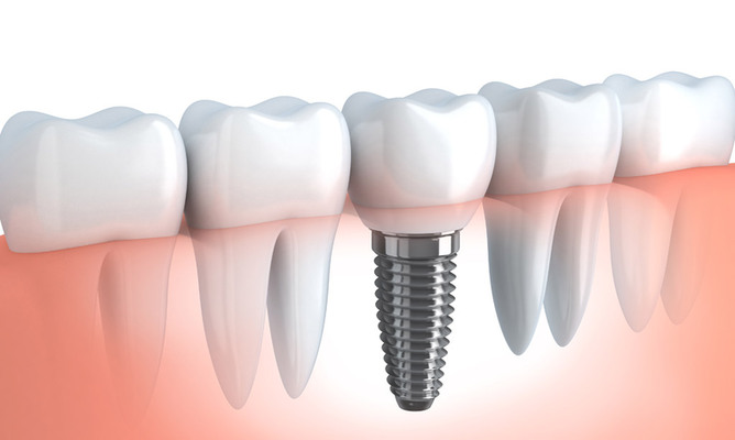 How to choose Dental implants?